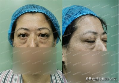 ​想要了解50到60岁提眉效果，来看看我提眉术后1-7天照片
