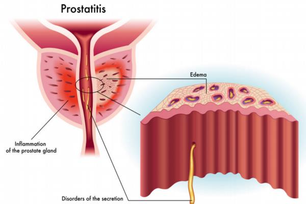 饮食多加这味改善前列腺肥大
