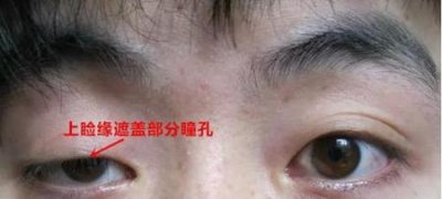 ​如何去除抬头纹女性(女生抬头纹怎么去除最有效)