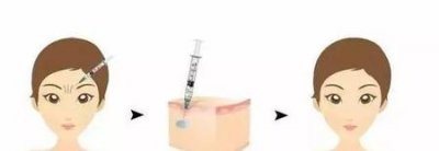 ​如何去掉眉心皱纹(皱眉川字纹代表什么)