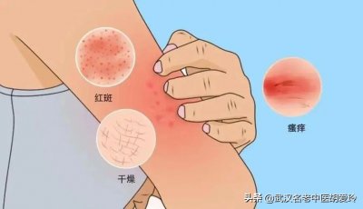 ​身上长跟蚊子咬的包一样很痒还传染