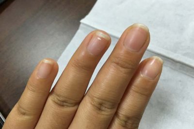 ​指甲上都是竖纹是什么原因（指甲上长竖纹，越长越多，和什么原因有关？）