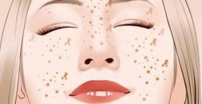 ​激光祛雀斑效果怎么样啊