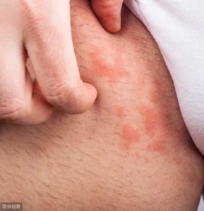 ​荨麻疹吃什么水果好（荨麻疹吃什么水果好？长了荨麻应该应多吃这）