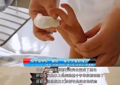 ​指甲薄软是什么原因(成人手指甲软是什么原因)